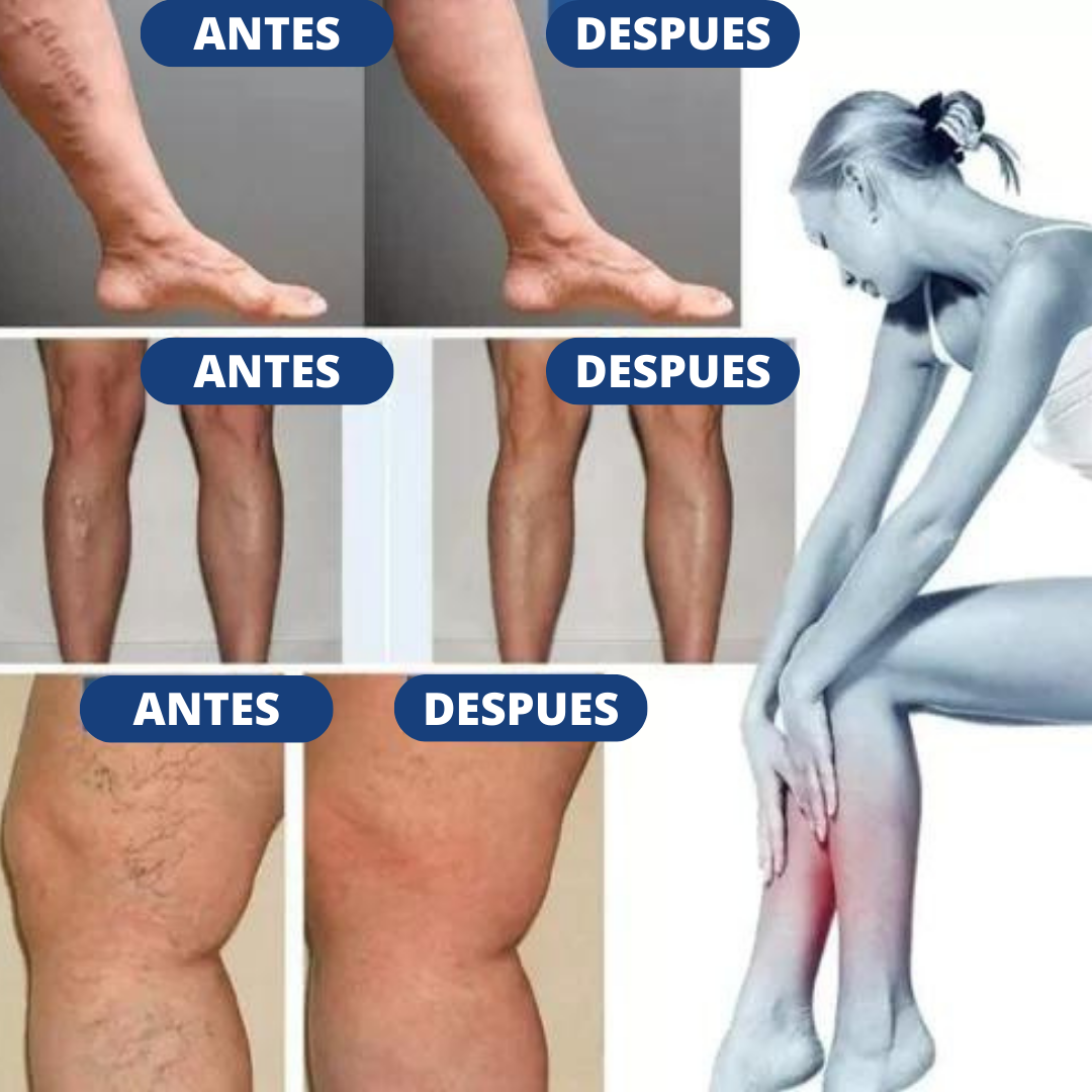 Varipro™ - Parche para Varices ( PACK 10 UNIDADES ) 🎁ESPECIAL ULTIMO DIA 2x1🎁