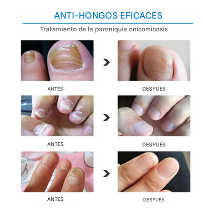 CREMA HONGOS PARA UÑAS NATURAL